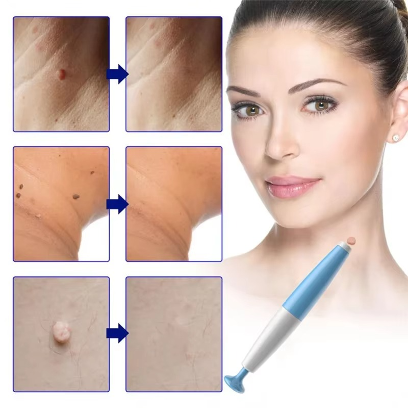 Tokyo Mart Skin Tag Remover