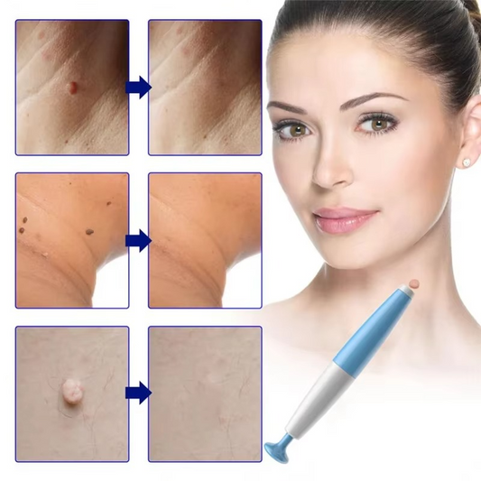 Tokyo Mart Skin Tag Remover